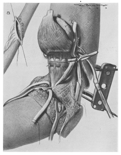 Illustration for article titled We've got hand transplants and face transplants... could brain transplants be next?